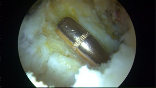 It is astonishing where bullets end up. We found this one deep inside a hip joint.